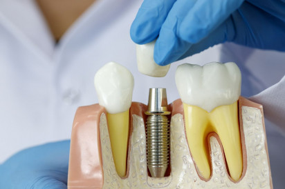 Что входит в услугу имплантация зубов под ключ?