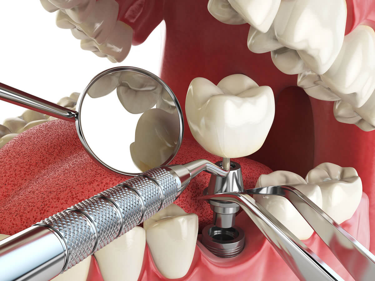 Что входит в услугу имплантация зубов под ключ?