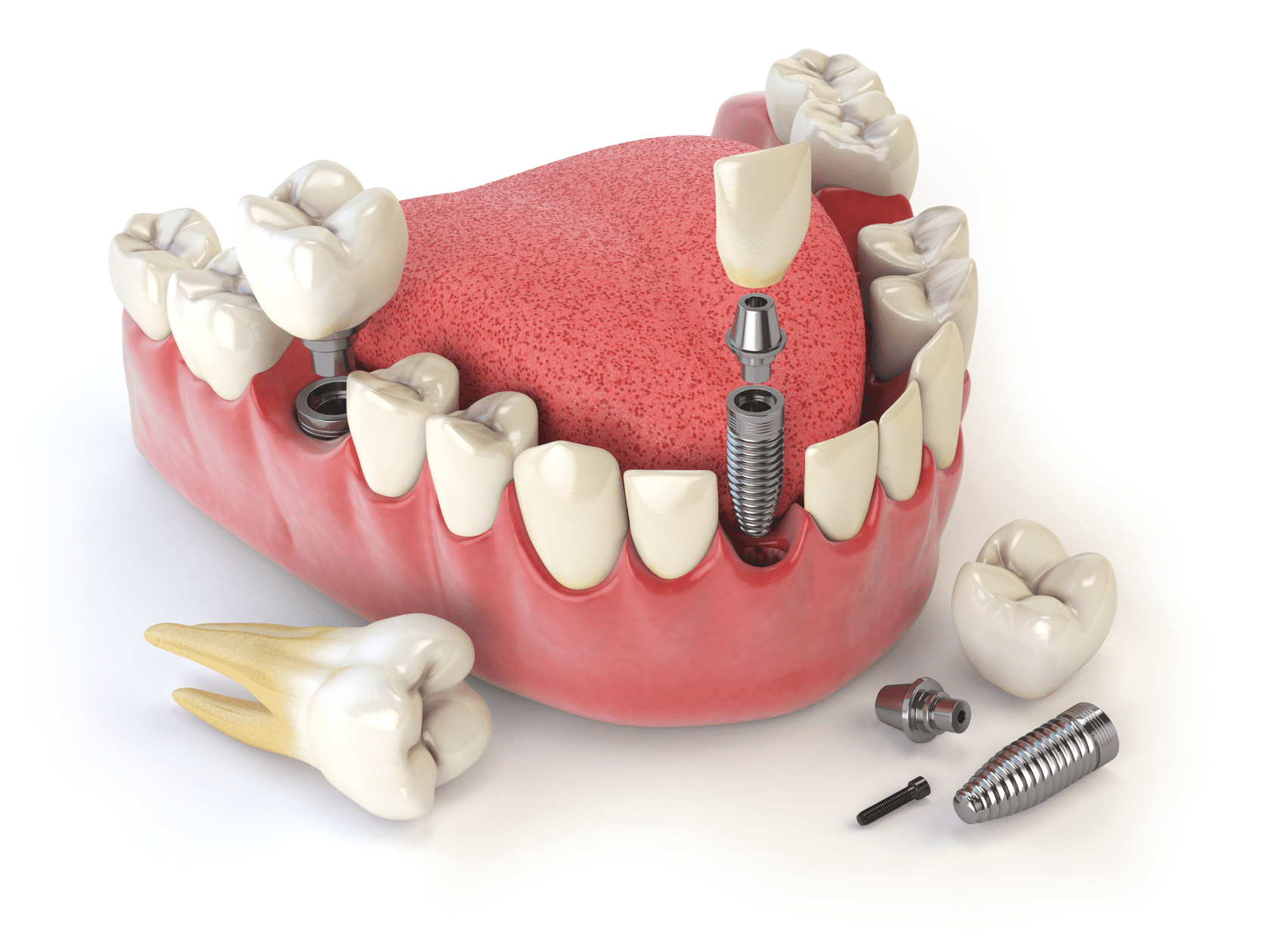 Протезирование зубов: цены и виды восстановления
