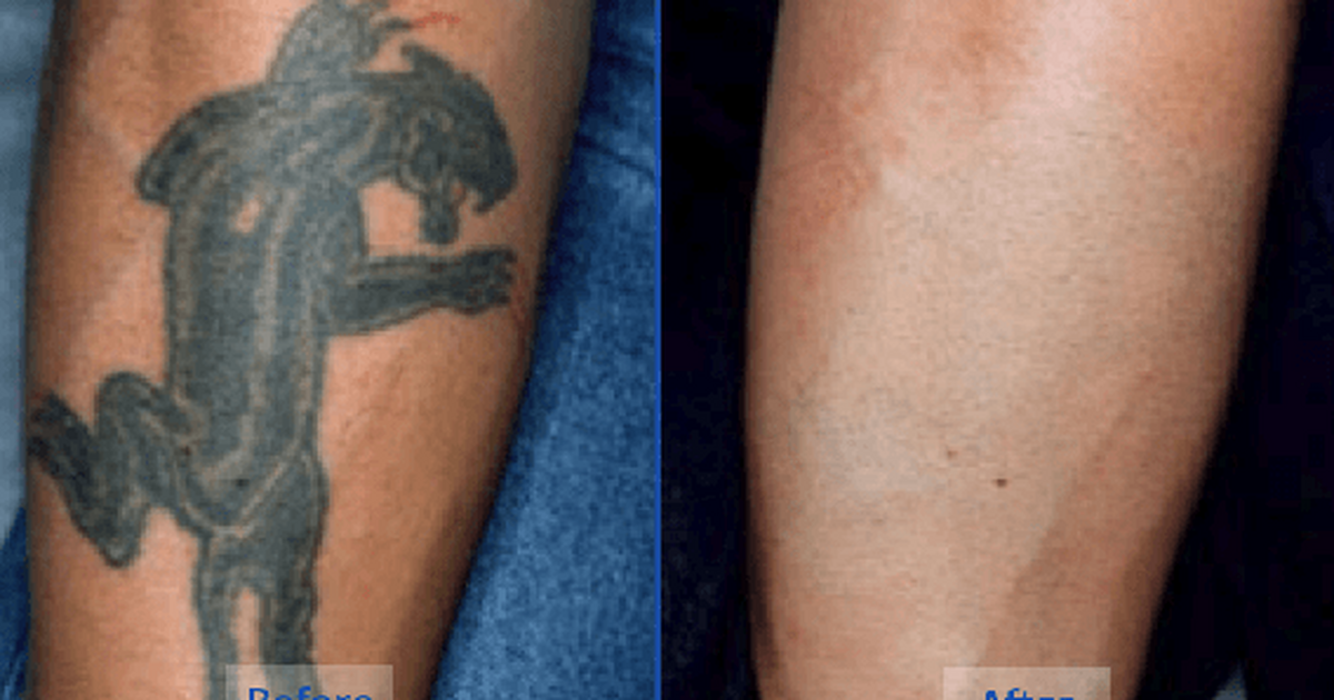 Важность удаления татуировок в профессиональных студиях