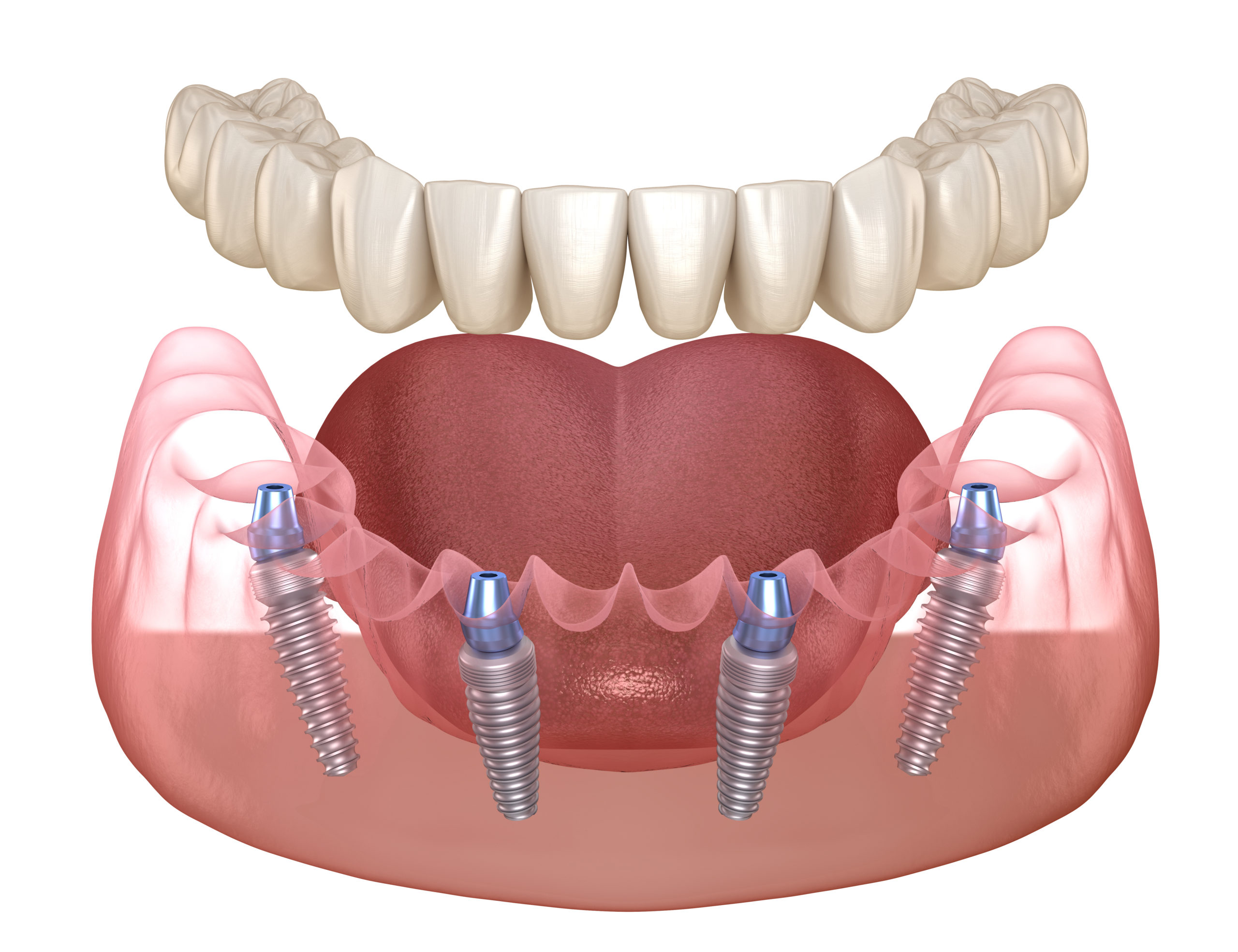 Имплантация зубов в Королеве: услуги стоматологической клиники «СеленаДент»