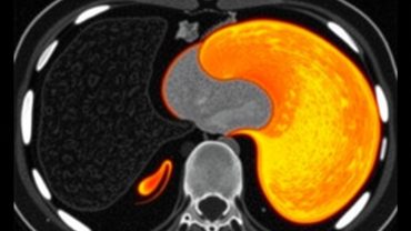 КТ печени с контрастом: что именно показывает и как это понять