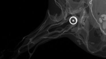 Внутрипротоковая папиллома: что это такое, почему появляется и как с ней поступать